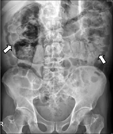 Pneumatosis in adults