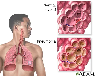 Pneumonia in adults