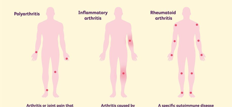 Polyarthritis