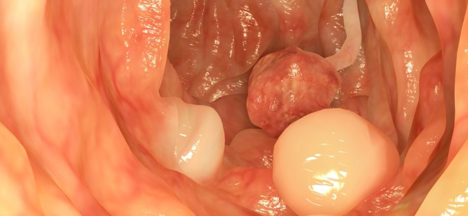 Polyps in the intestines in adults