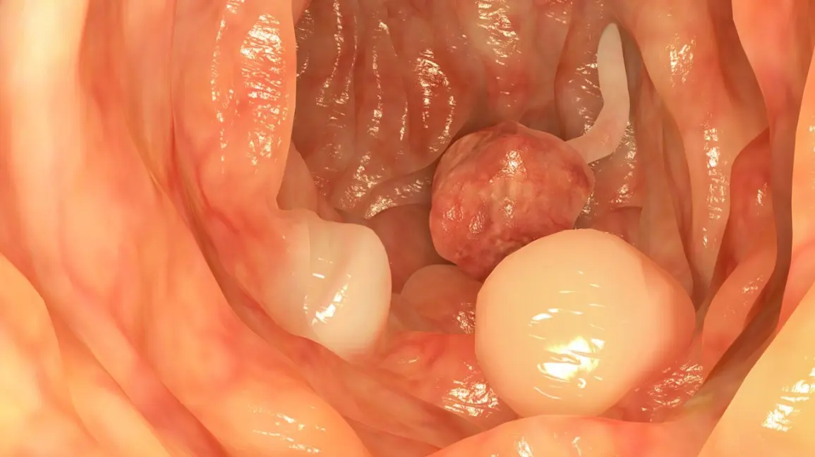 Polyps in the intestines in adults