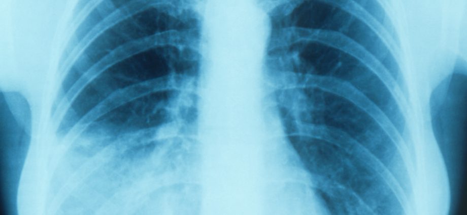 Polysegmental pneumonia in adults