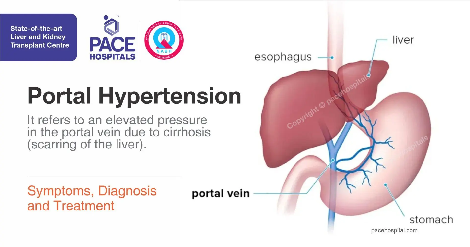 portal hypertension