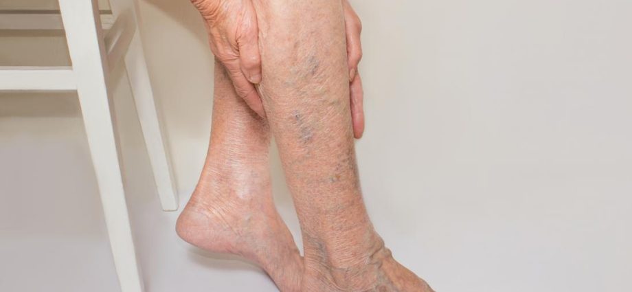 Prevention of varicose veins in the legs