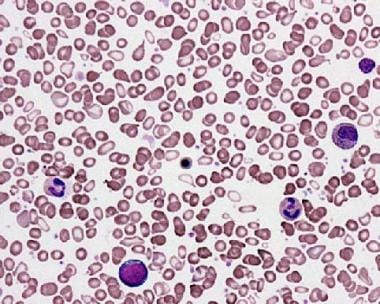 Primary myelofibrosis