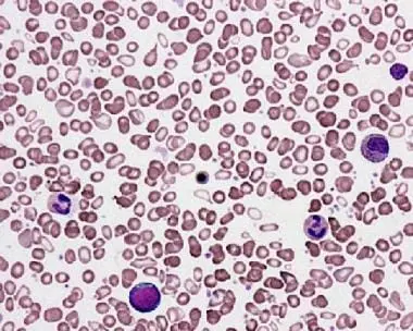 Primary myelofibrosis