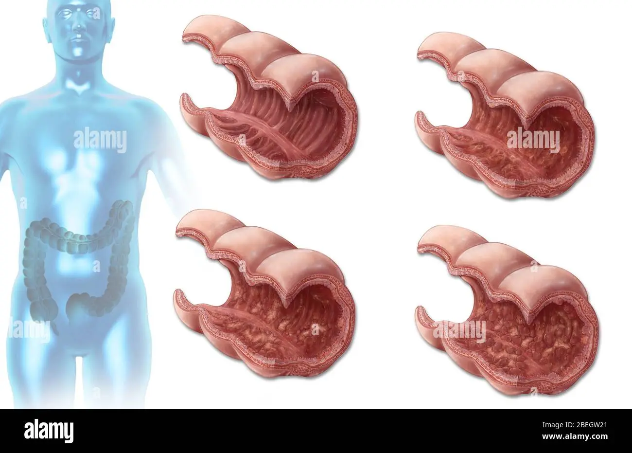 Proctitis in adults