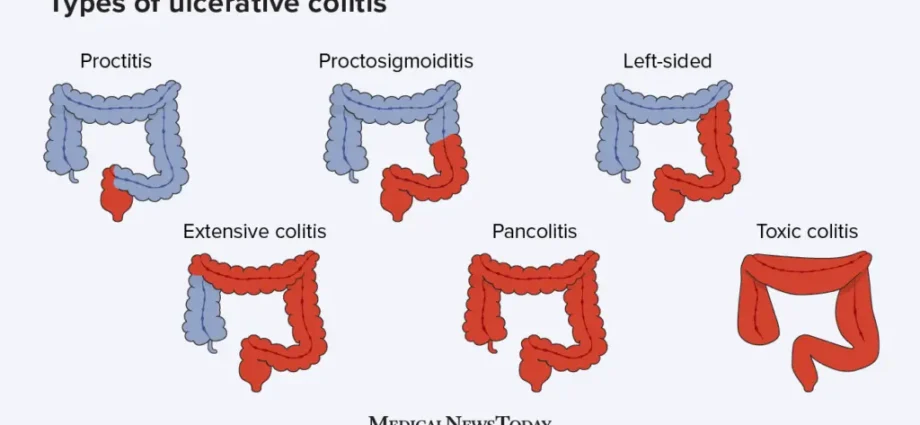 Proctosigmoiditis in adults