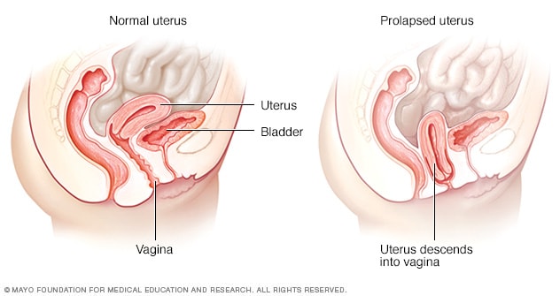 Prolapse of the uterus