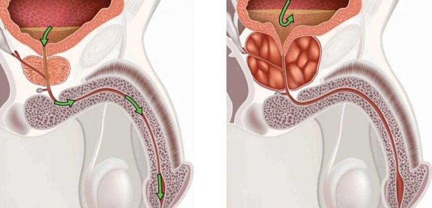 Prostatitis and sedentary lifestyle