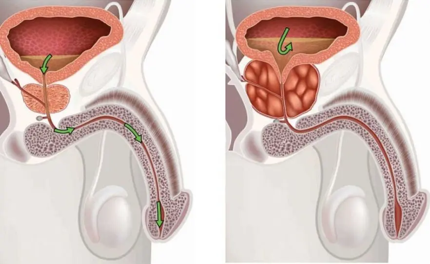 Prostatitis and sedentary lifestyle