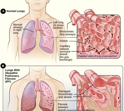 Pulmonary fibrosis in adults