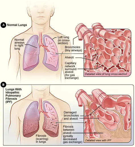 Pulmonary fibrosis in adults