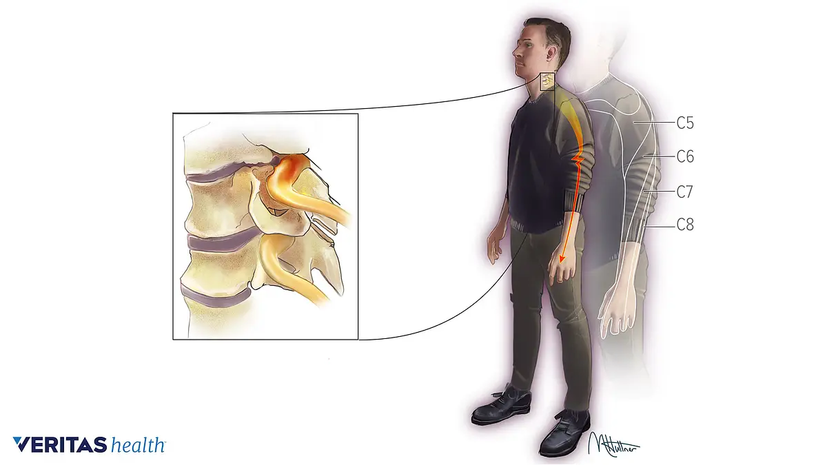 Radiculitis