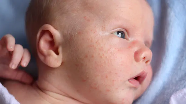 Rash on the face of a newborn