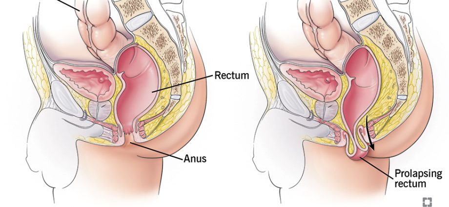 Rectal prolapse in adults