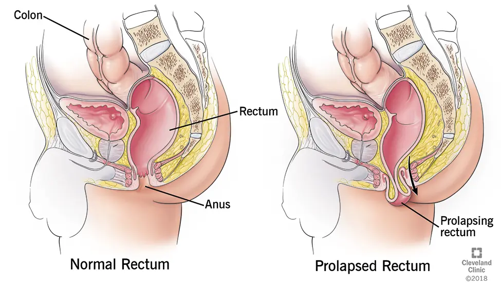 Rectal prolapse in adults