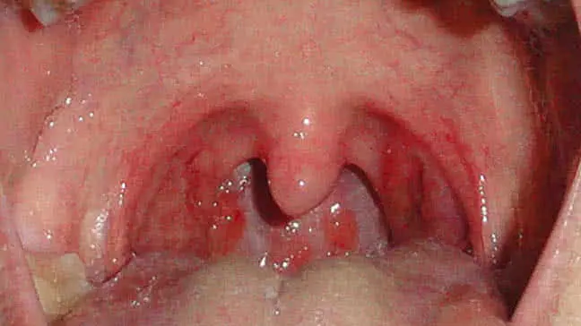 Red throat in adults