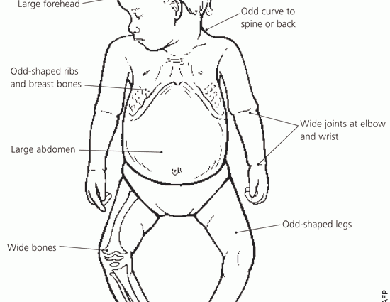 Rickets in children