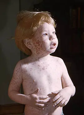 Rubella in children