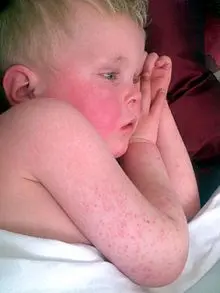 Scarlet fever in children