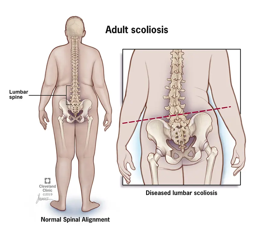 Scoliosis of the spine in adults