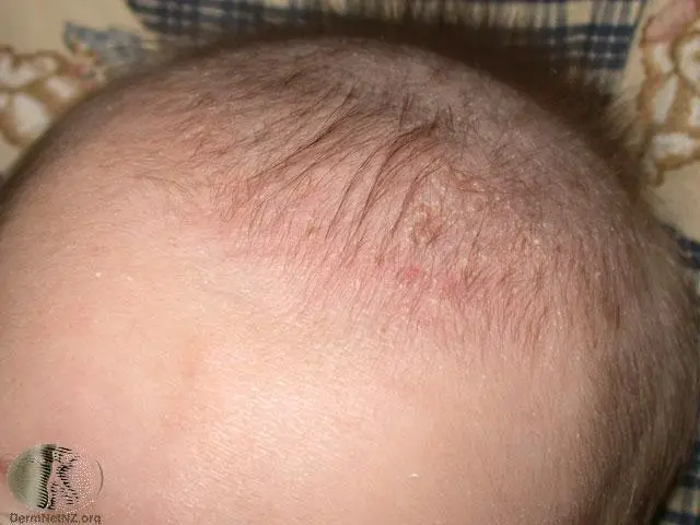 Seborrheic dermatitis in a child on the head