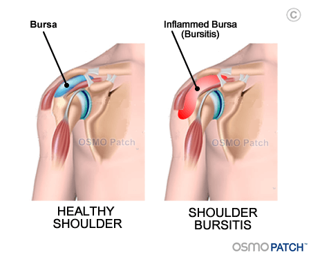 Shoulder bursitis in adults