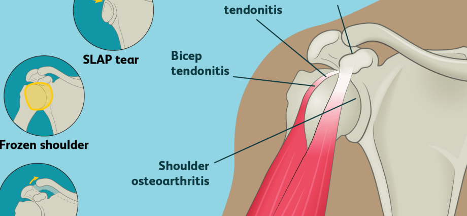 Shoulder strain in adults