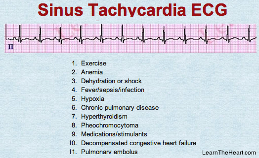 Sinus tachycardia in adults