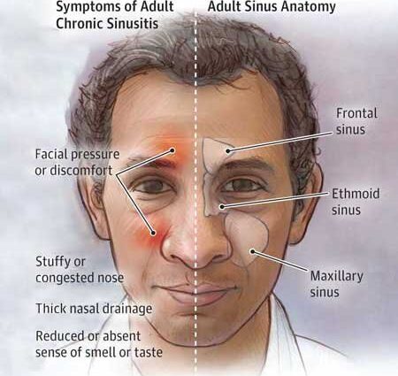 Sinusitis in adults