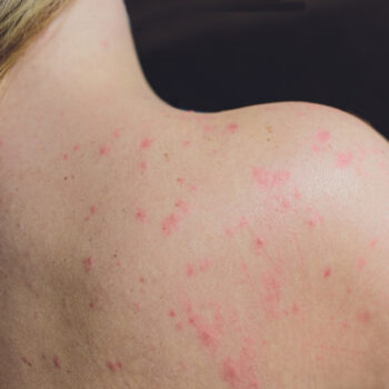 Skin irritation in adults