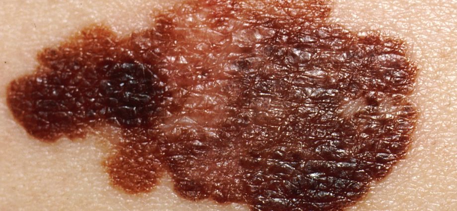 skin melanoma