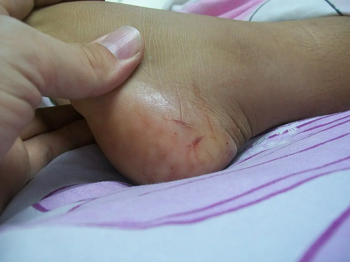 Snake bite