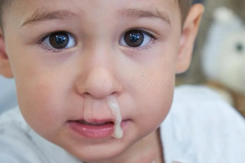 Snot in a child