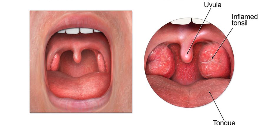 Sore throat when swallowing