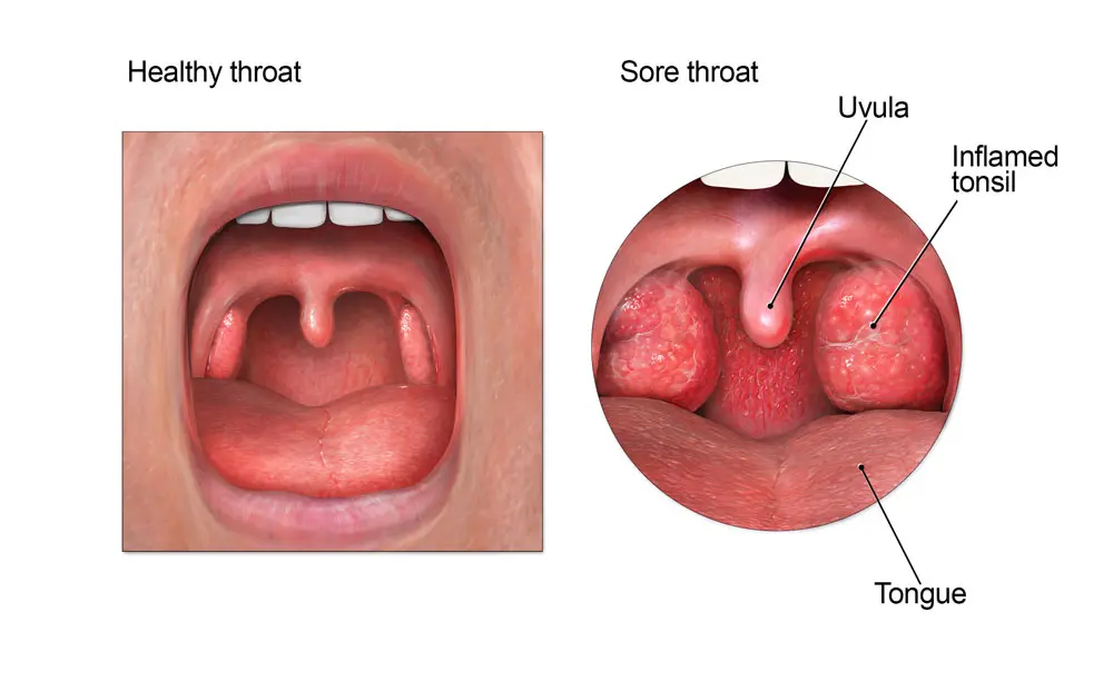 Sore throat when swallowing