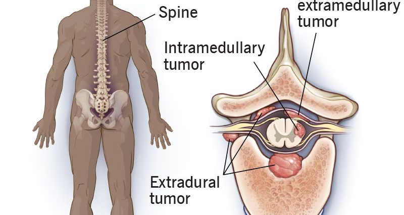 Spinal cord tumor in adults