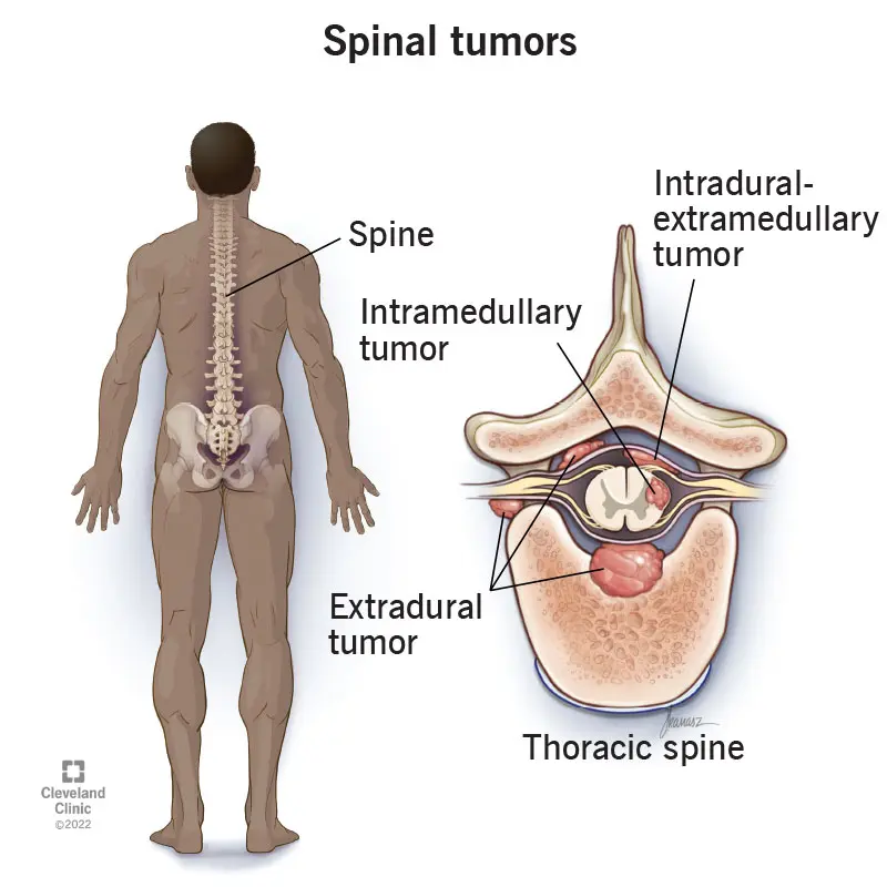 Spinal cord tumor in adults