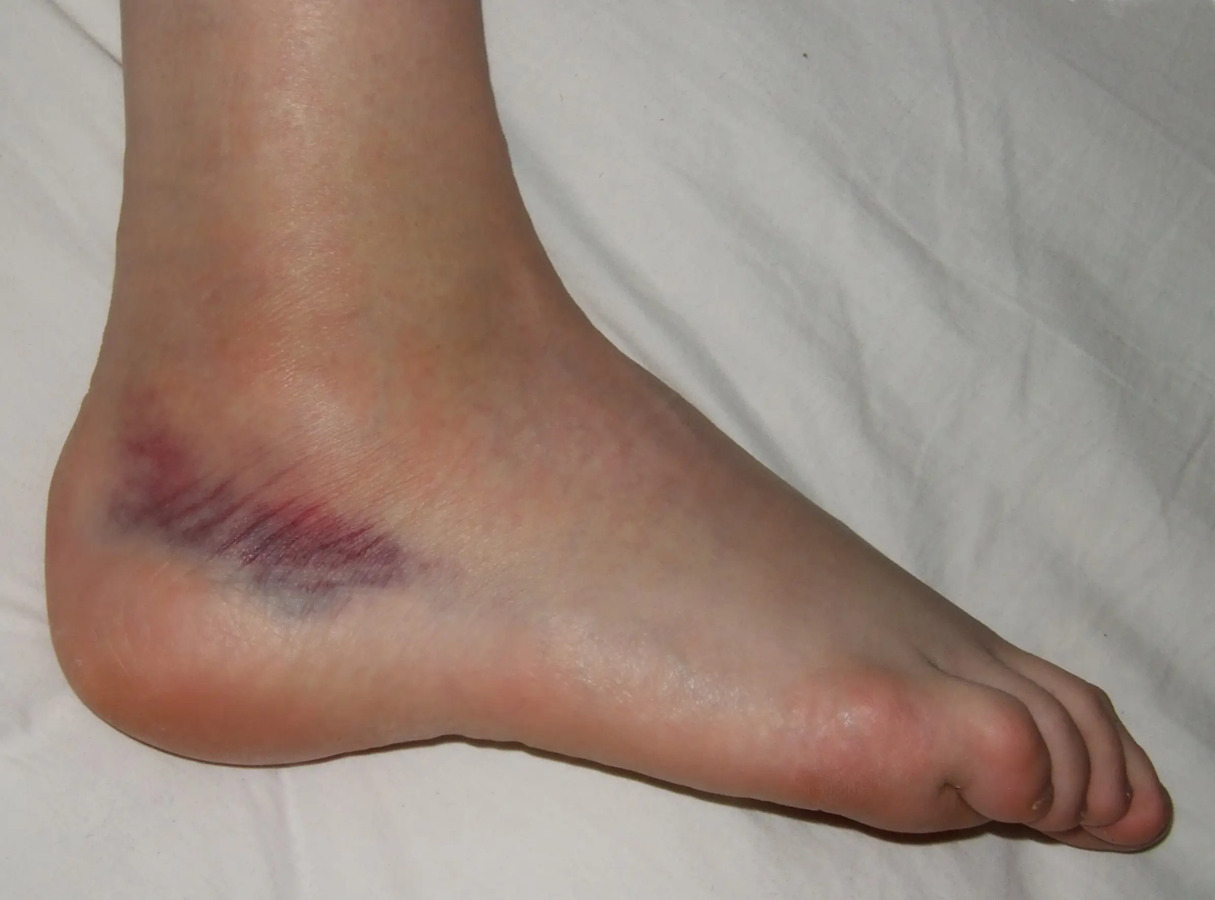 Sprain in adults