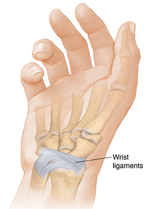 Sprain of the ligaments of the hand in adults