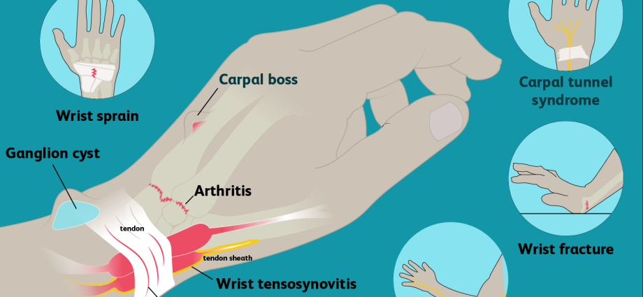 Sprained wrist in adults