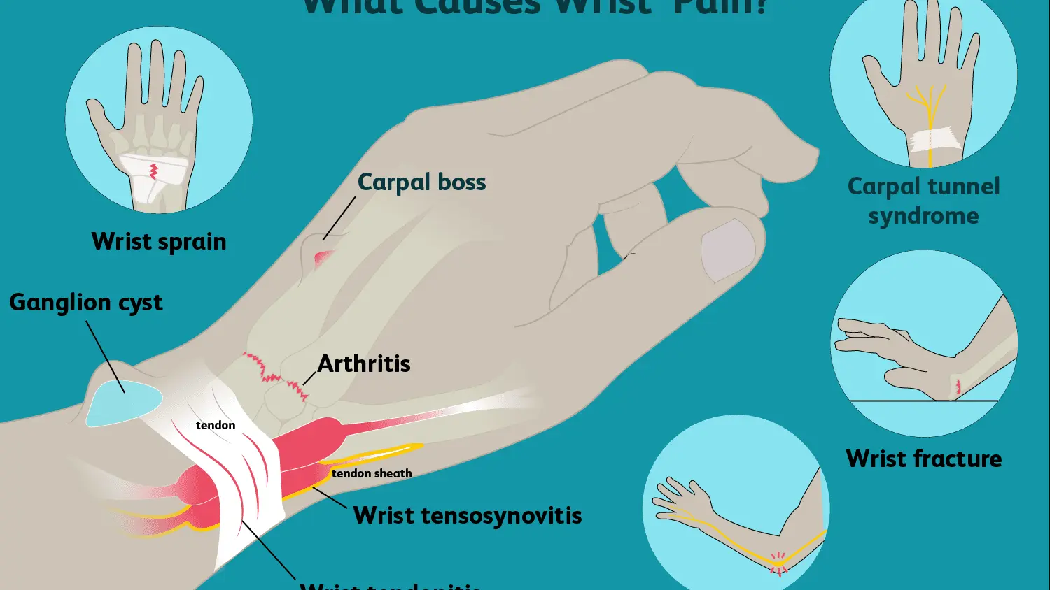 Sprained wrist in adults