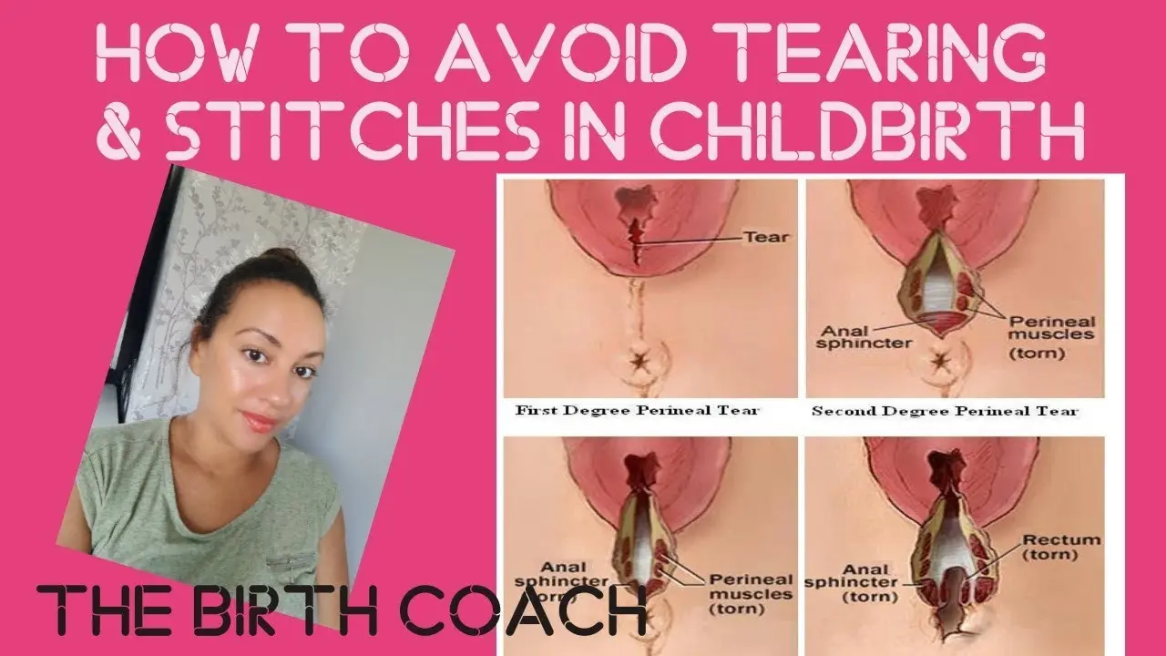 Stitches after childbirth