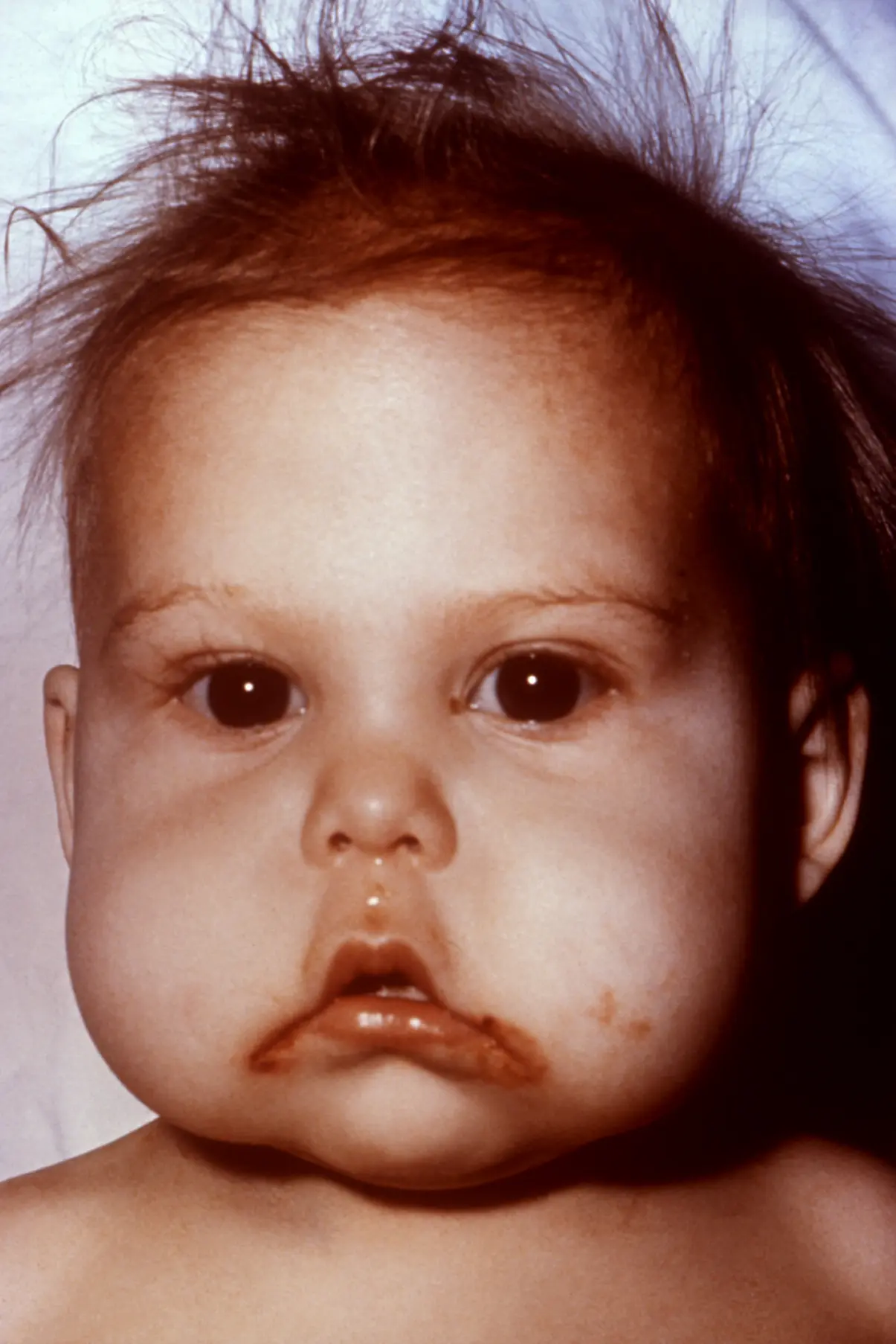 Stomatitis in a child