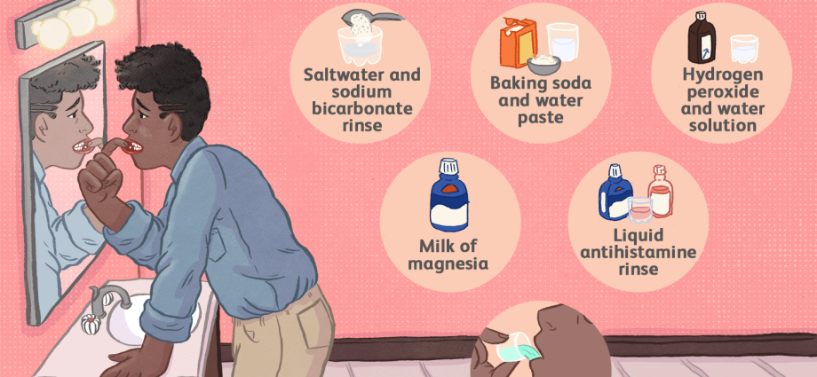 Stomatitis in adults: how to treat at home