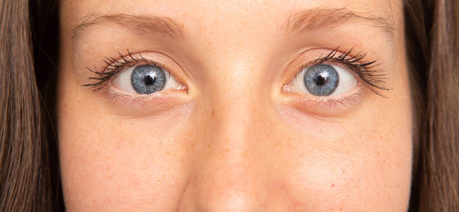 Strabismus in adults