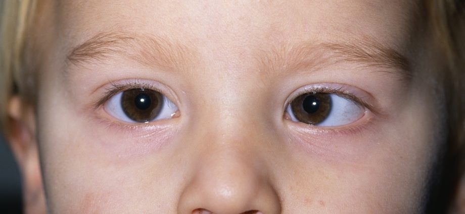 Strabismus in children