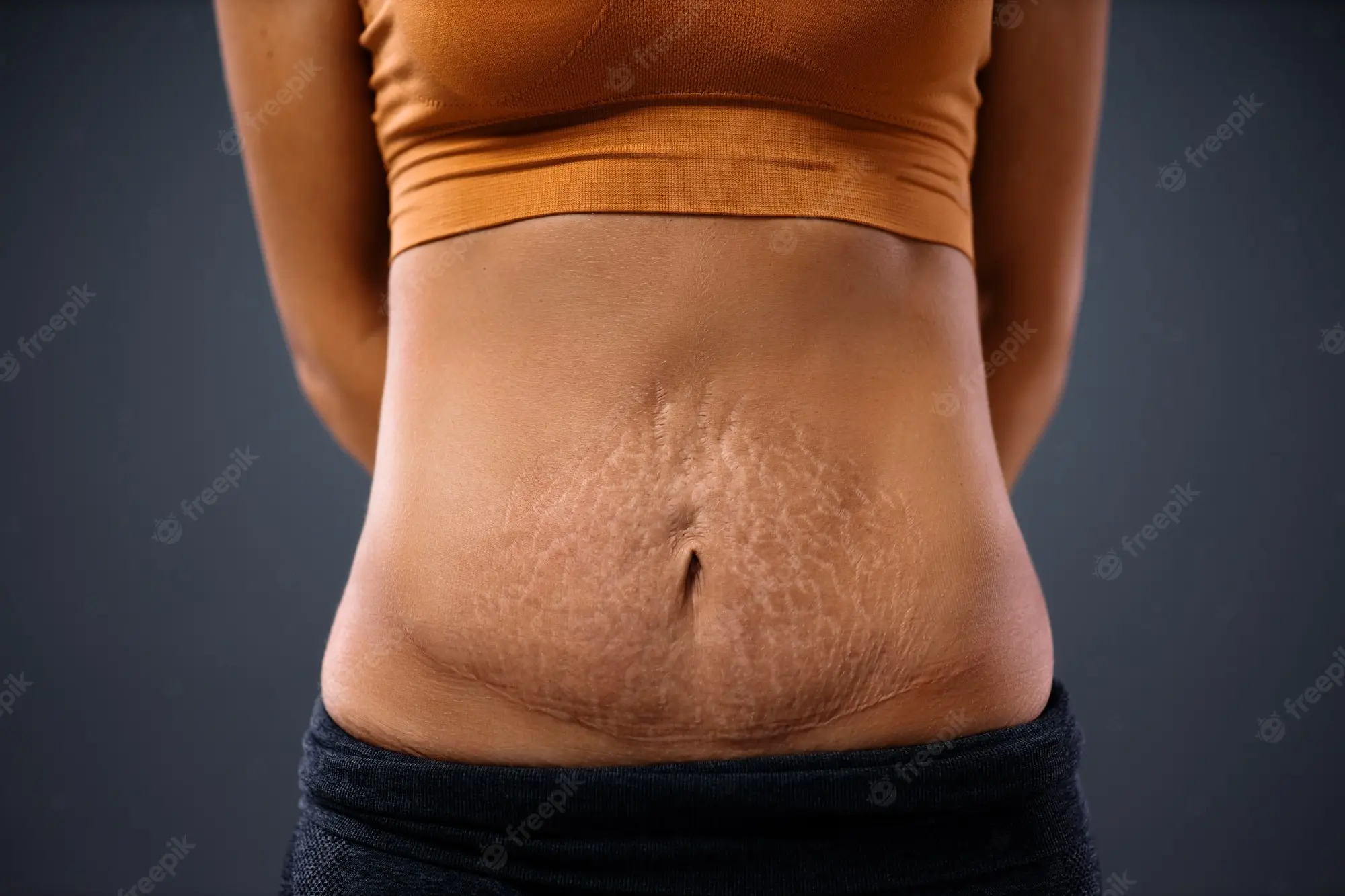 Stretch marks on the abdomen after childbirth