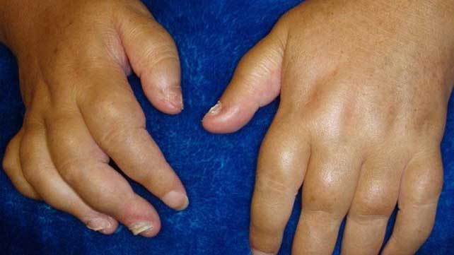 Swelling of the hand in adults